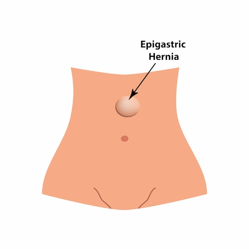 Graphic showing an epigastric hernia