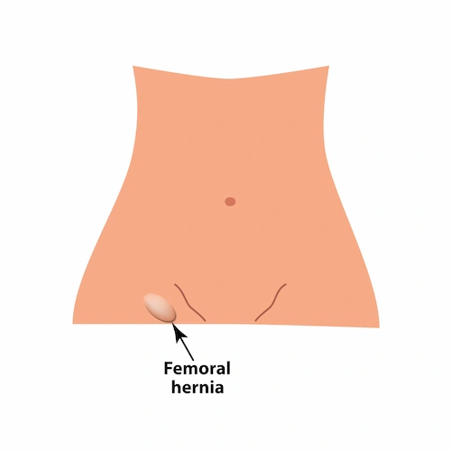 Graphic showing the location of a femoral hernia