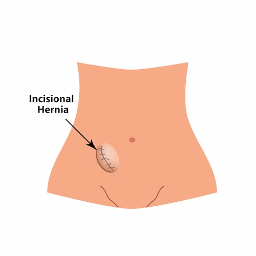 Graphic showing the location of a incisional hernia