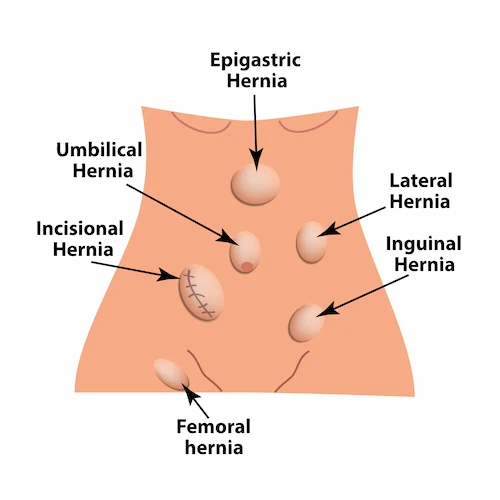 Graphic showing the different types of hernias