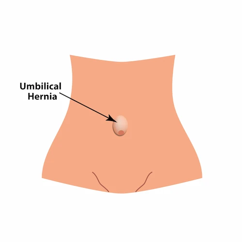 Graphic showing the location of a umbilical hernia